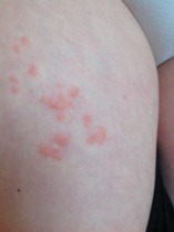 DD has a rash