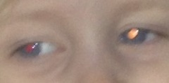 Red eye reflex
