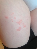 DD has a rash