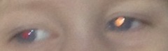 Wanted optometrist advice about squint
