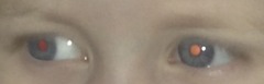 Wanted optometrist advice about squint