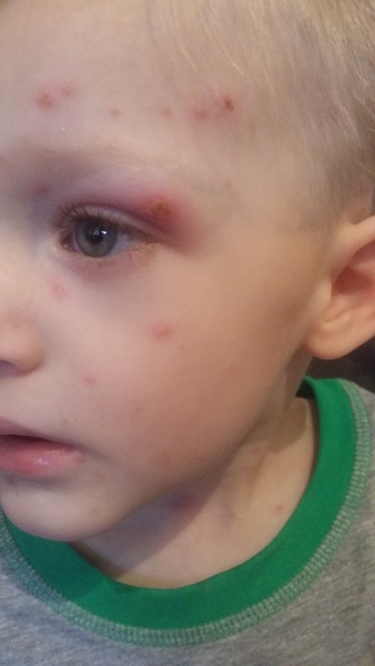 Chicken pox