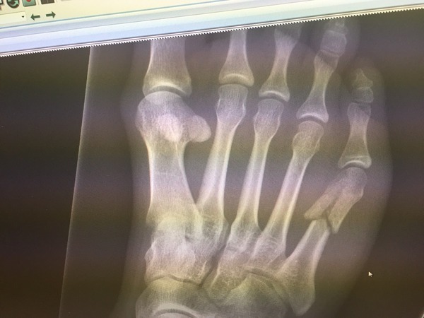 Broken foot
