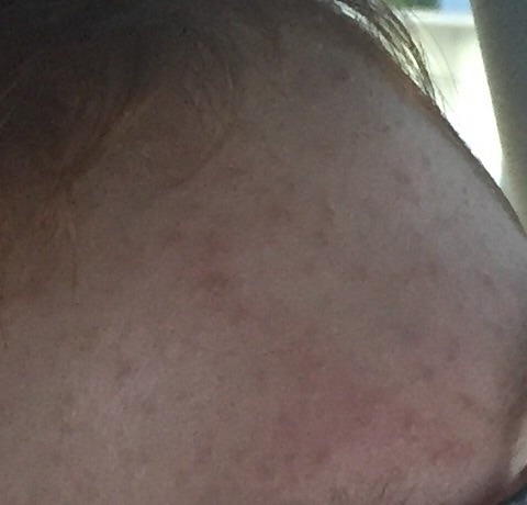 11year old boy acne... help!!