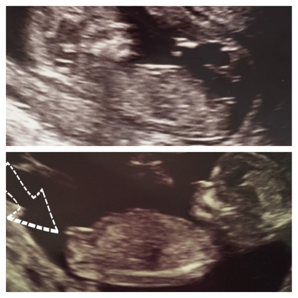 Gender prediction-nub theory
