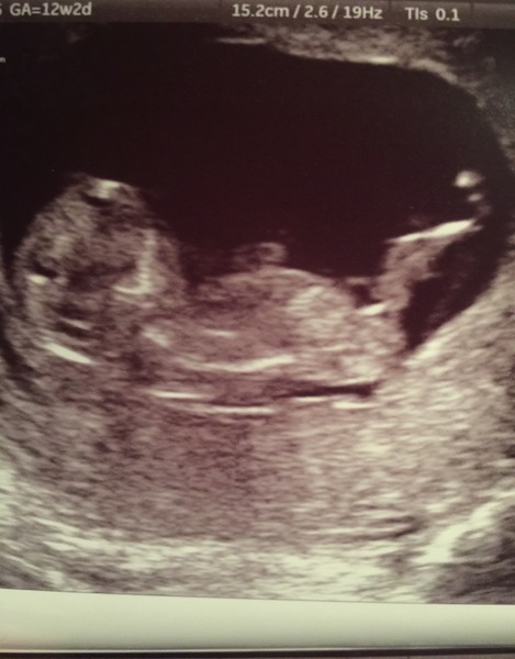 August 2016 (3) - scans fast approaching, teeny tiny bumps appearing, and sickness easing....we hope!