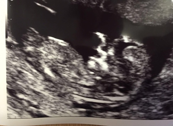 August 2016 (3) - scans fast approaching, teeny tiny bumps appearing, and sickness easing....we hope!