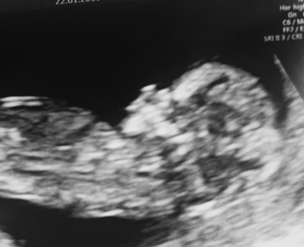 August 2016 (3) - scans fast approaching, teeny tiny bumps appearing, and sickness easing....we hope!