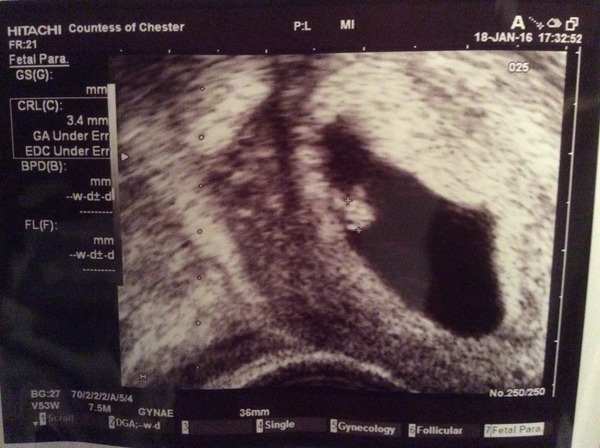 Would you be my Infertility/Clomid/Follicle tracking friend please?!