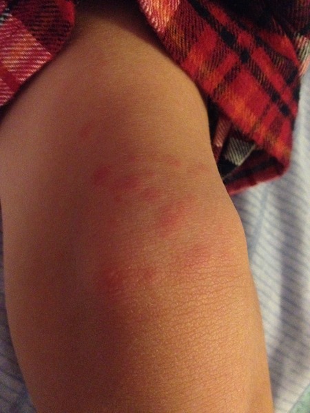 7 year old with sudden hives