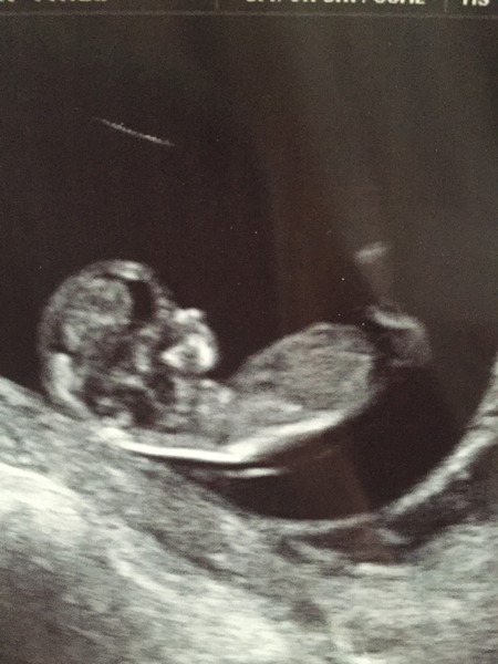 August 2016 (3) - scans fast approaching, teeny tiny bumps appearing, and sickness easing....we hope!