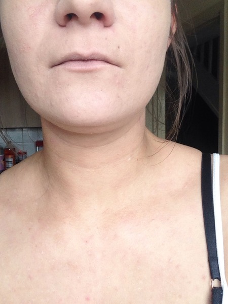 foundation for very dry-psoriasis skin. (photos)