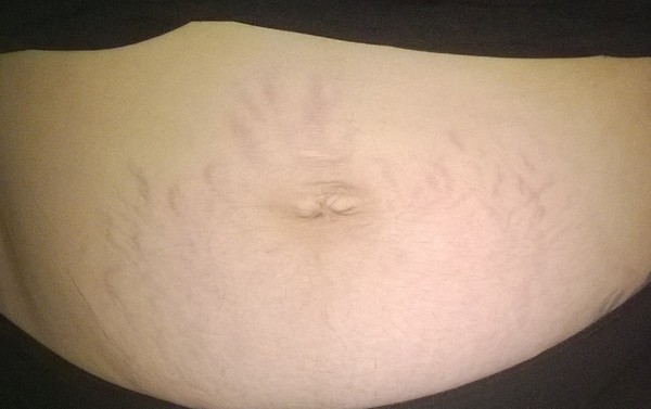 hole in my stomach muscles and sore incision question (gross picture included too - sorry)