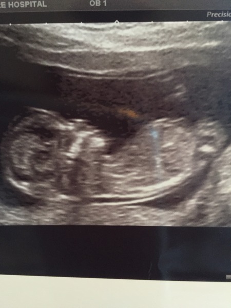 boy or girl