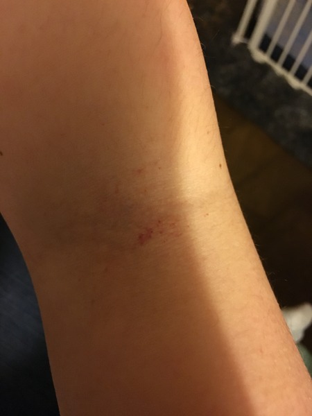What is this rash?