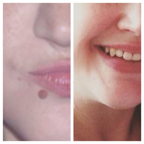 Aibu to want the mole on my face removed?