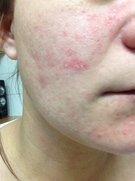 foundation for very dry-psoriasis skin. (photos)