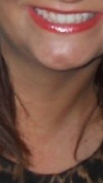 Tooth whitening. Please help!