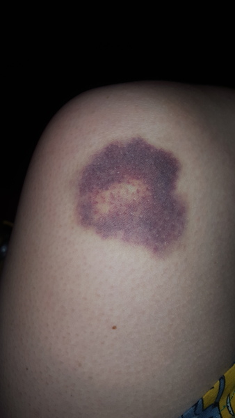 To ask any medical minds for an opinion on my thigh...
