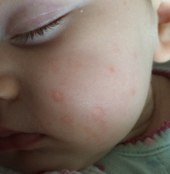 rash / spot / blotch
