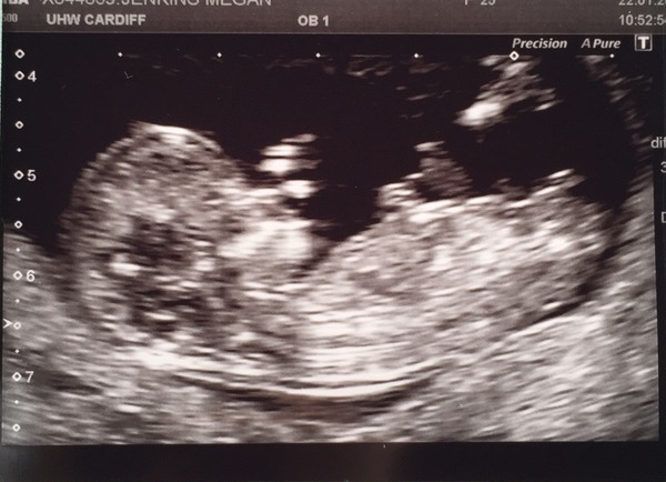 August 2016 (3) - scans fast approaching, teeny tiny bumps appearing, and sickness easing....we hope!
