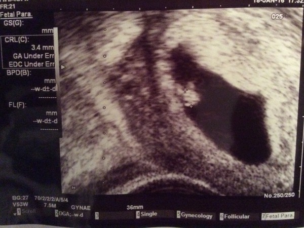 Had a reassurance scan today and just had to share...