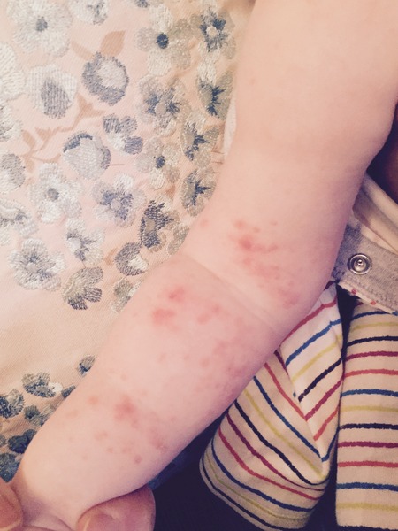 Is this chickenpox