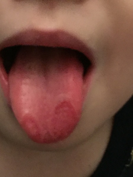 My ds's tongue looks like this ...