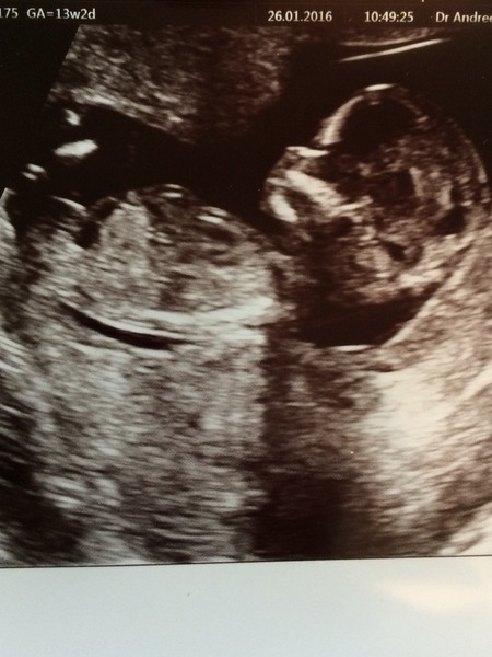 August 2016 (3) - scans fast approaching, teeny tiny bumps appearing, and sickness easing....we hope!