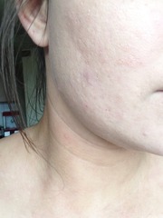 foundation for very dry-psoriasis skin. (photos)