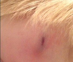Strange scar after bump to head...