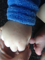 Rash on hands and feet (pics)