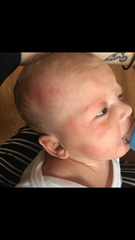 10 week old keeps coming out in hives, I thought it was a pollen allergy. Advice please!