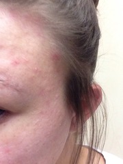 foundation for very dry-psoriasis skin. (photos)