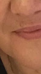 Facial mole - keep it or have a scar?