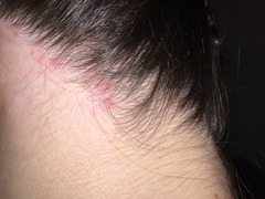 Does anyone know what these spots are on my scalp?