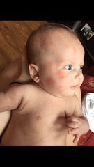 10 week old keeps coming out in hives, I thought it was a pollen allergy. Advice please!