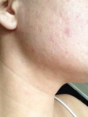 foundation for very dry-psoriasis skin. (photos)