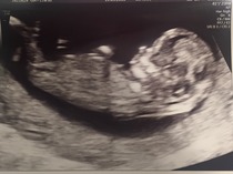 August 2016 (3) - scans fast approaching, teeny tiny bumps appearing, and sickness easing....we hope!