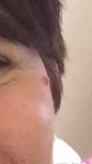 Facial mole - keep it or have a scar?