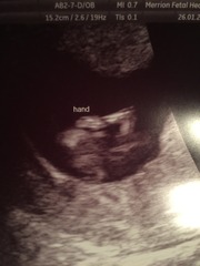 August 2016 (3) - scans fast approaching, teeny tiny bumps appearing, and sickness easing....we hope!