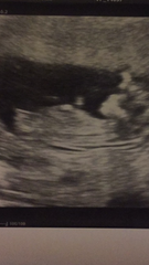 Baby girl or baby boy? 12 weeks 5 days
