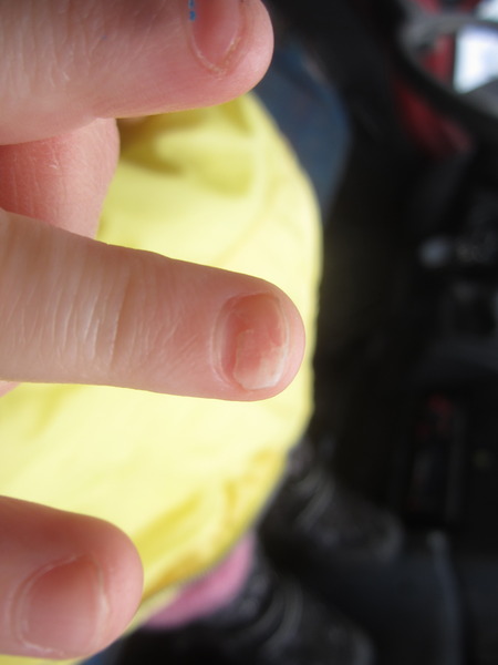 Extreme nail biting