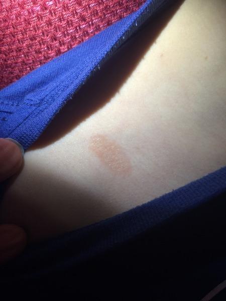 Does this look like ringworm?