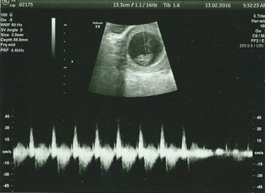 September 2016 (Thread 2) Booking in and 12 weeks scans soon!