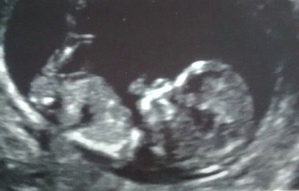 August 2016 (3) - scans fast approaching, teeny tiny bumps appearing, and sickness easing....we hope!