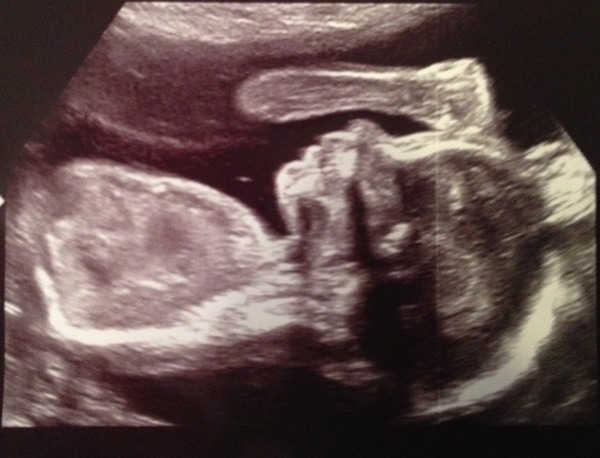 June 2016 #7 - We're still waiting for the second trimester "bloom" but healthy babies and stronger kicks all around!!