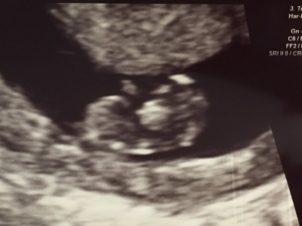 September 2016 (Thread 2) Booking in and 12 weeks scans soon!