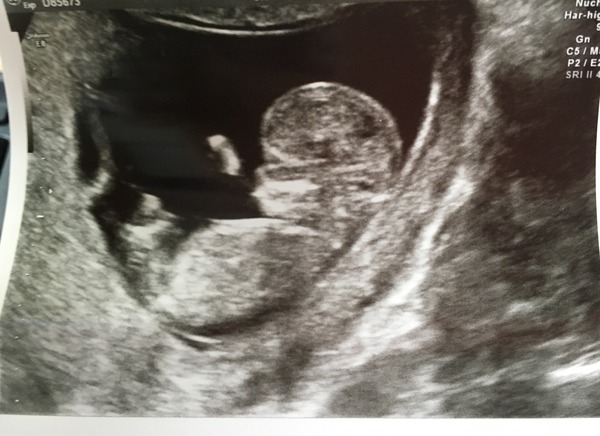 September 2016 (Thread 2) Booking in and 12 weeks scans soon!