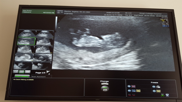 September 2016 (Thread 2) Booking in and 12 weeks scans soon!